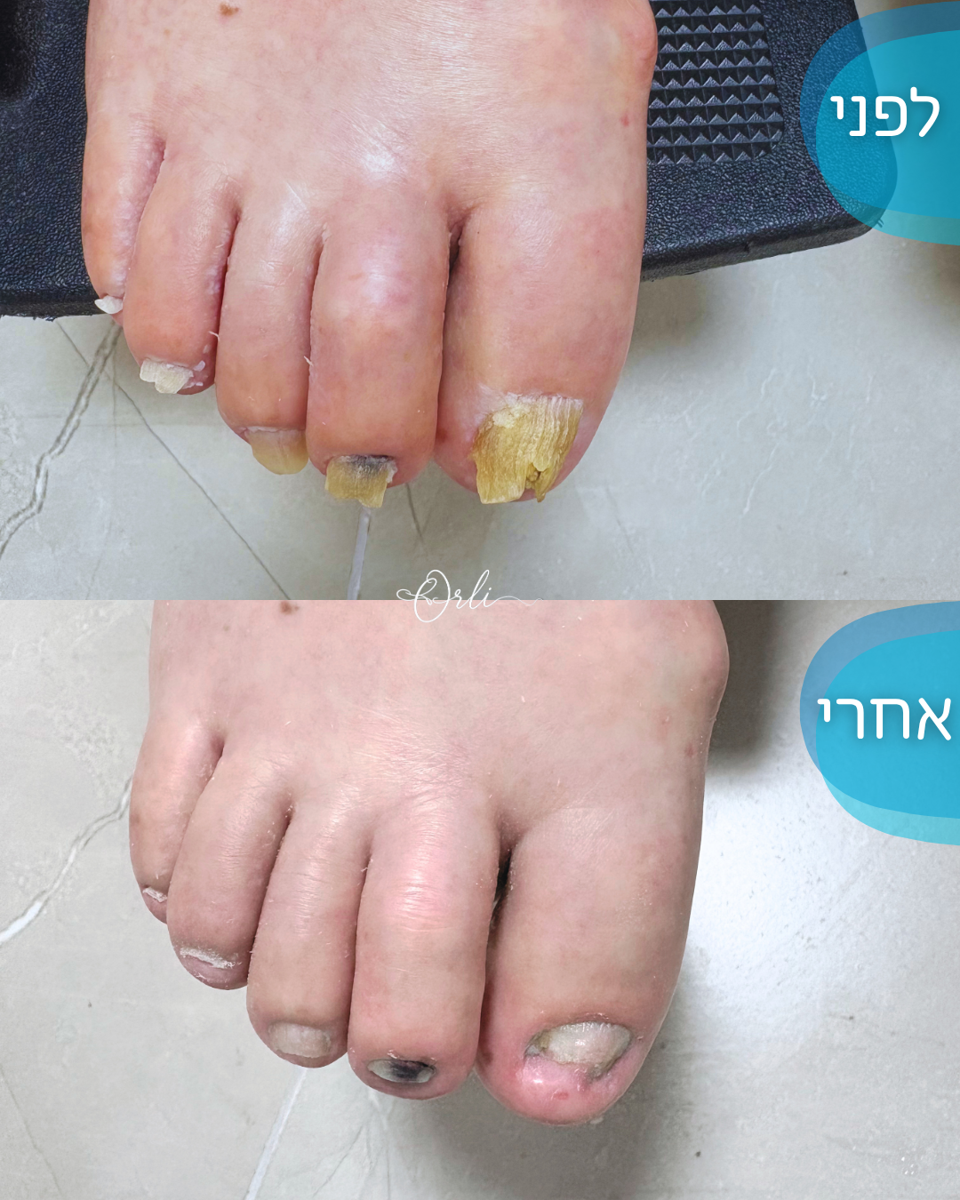 עבודה אמיתית בכפות הרגליים — לפני ואחרי