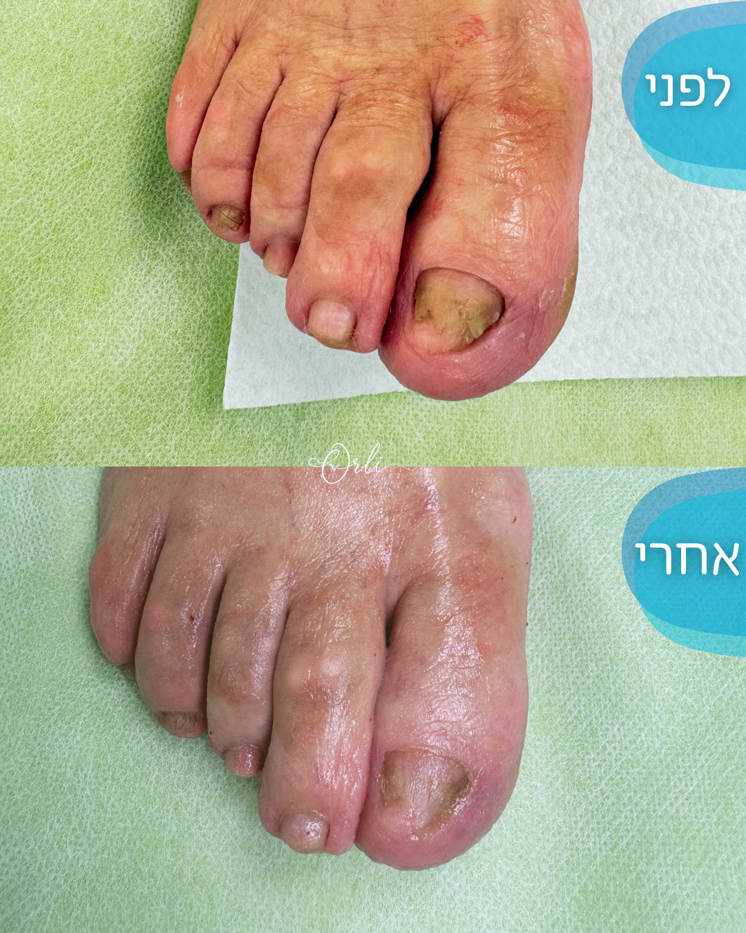 תהליך טיפול בכף הרגל — לפני ואחרי