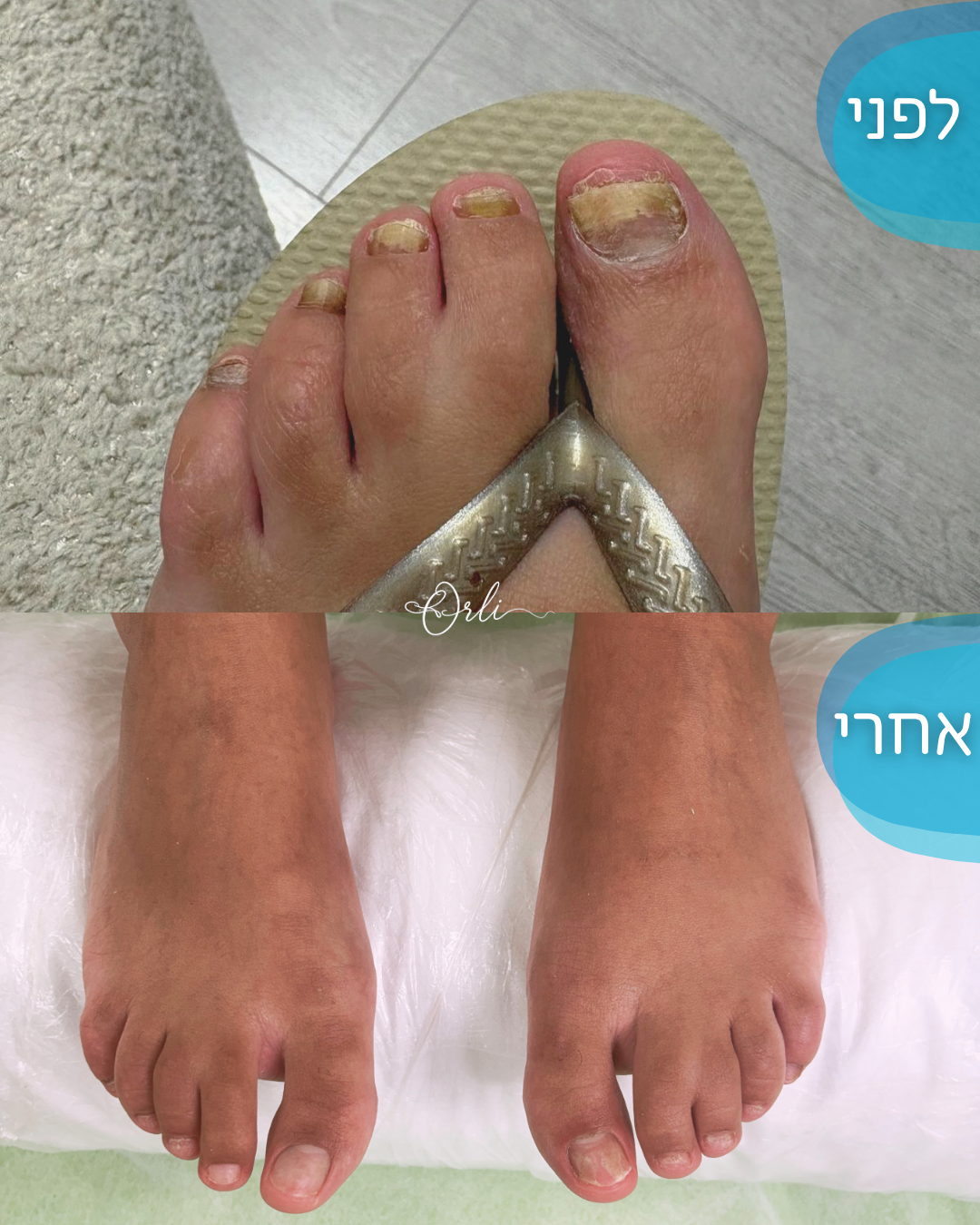 עבודה בכפות הרגליים — לפני ואחרי
